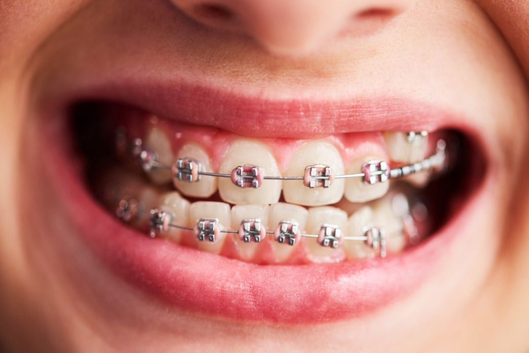 dental braces